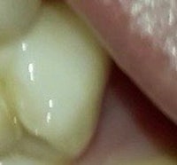 a close up of a person's tooth