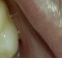 a close up of a person's mouth with a tooth in it