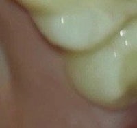 a close up of a tooth with a white filling