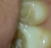 a close up of a person's tooth